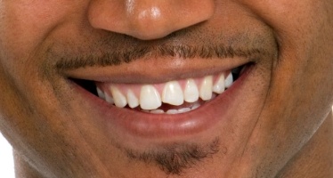 Closeup of smile with chipped front tooth