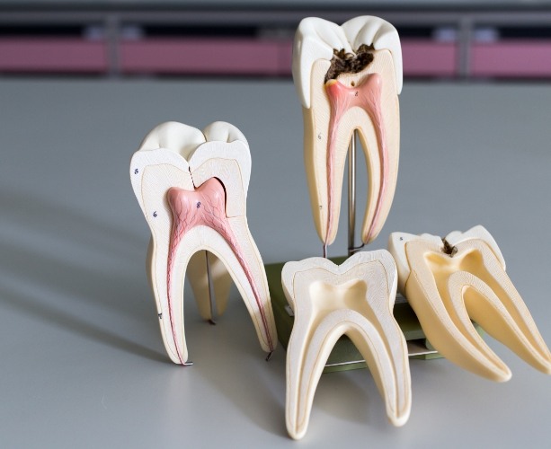 Healthy tooth and tooth in need of root canal models