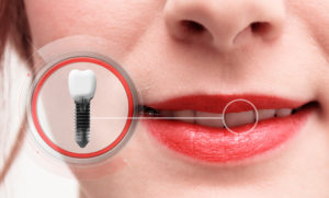 Graphic showing dental implant