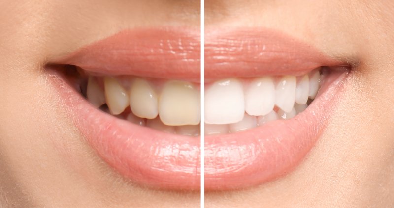 Teeth whitening results