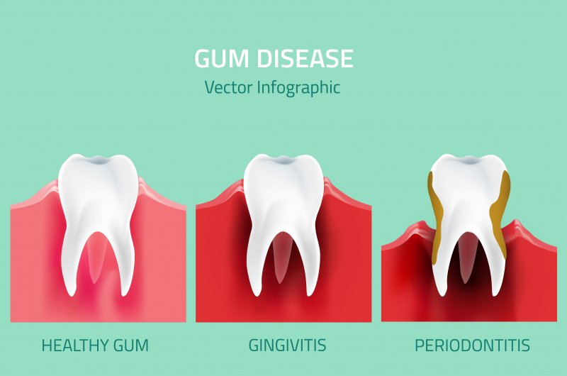 Diagram showing the stages of gum disease
