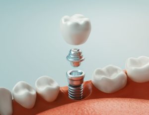 CGI illustration of a dental implant with metal rod in front of gray background